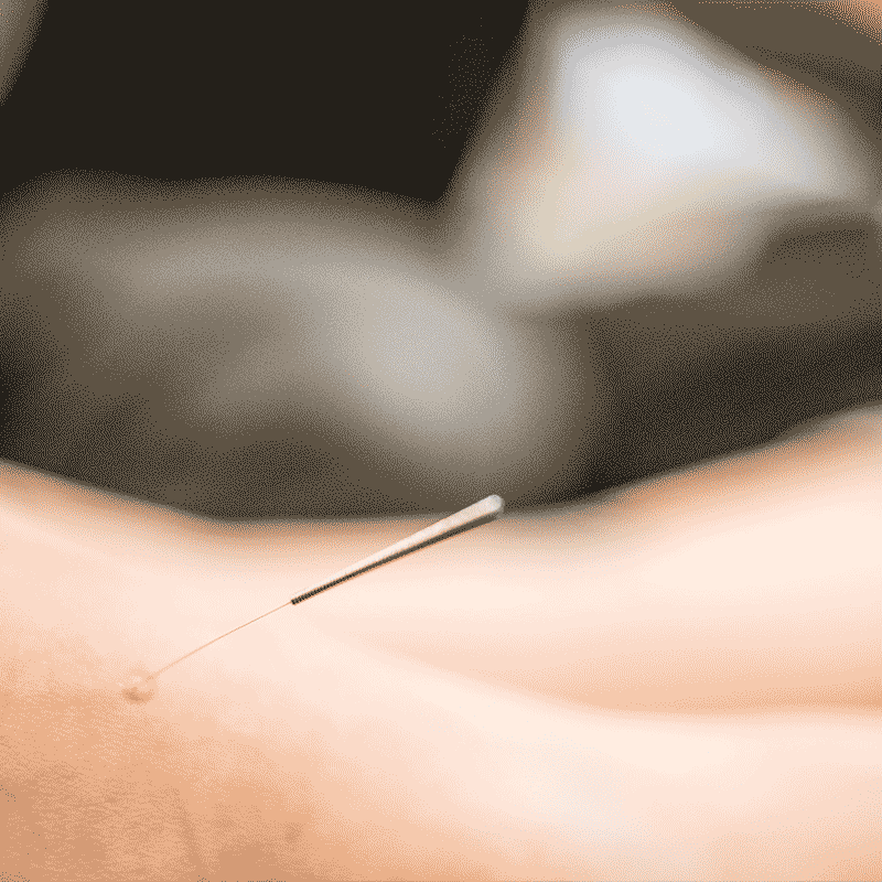 Featured image for “Acupuncture Therapy”